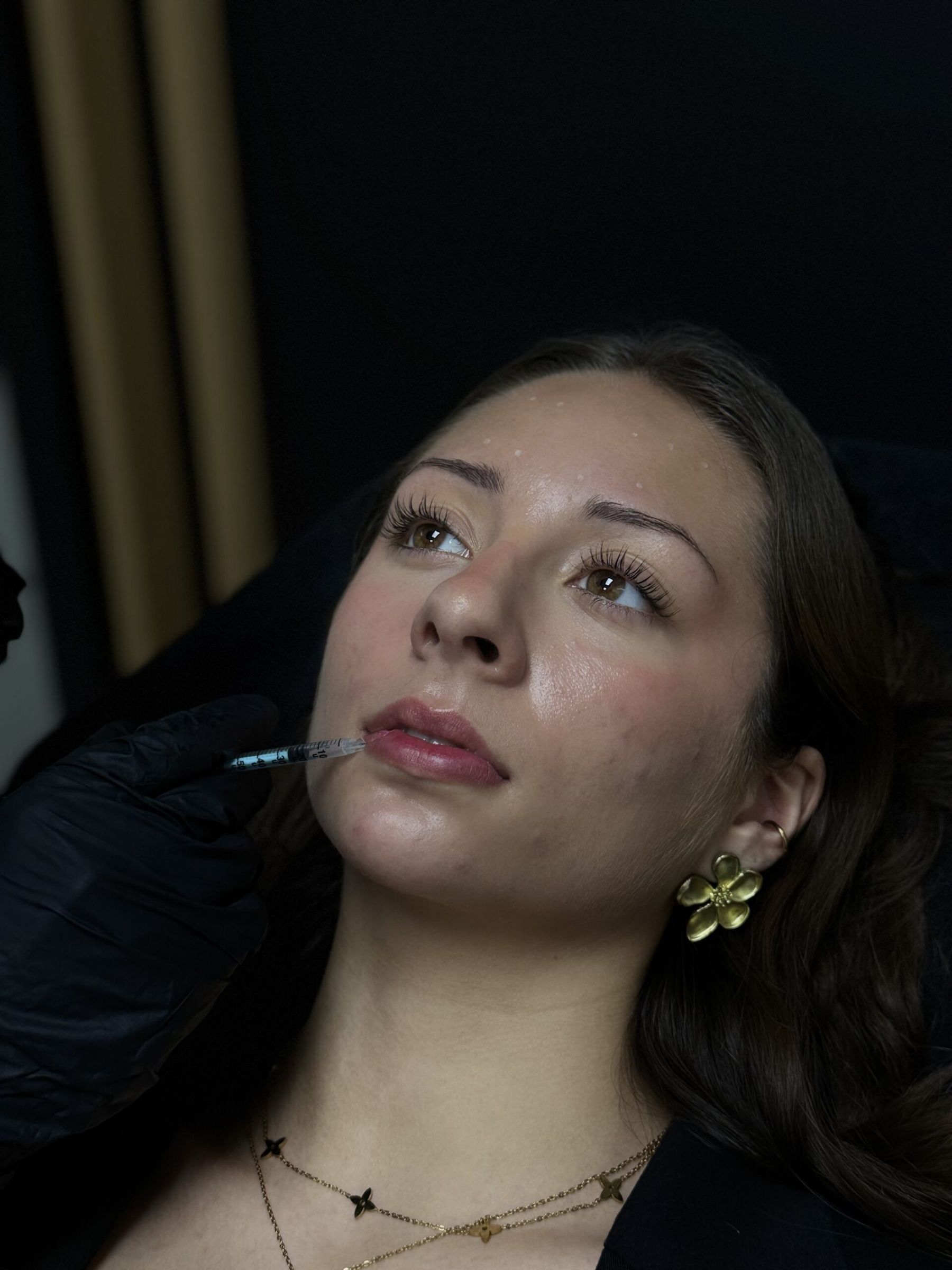 Injections d&rsquo;acide hyaluronique